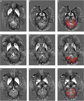 Brain <mark class="highlighted">iron content</mark> in cerebral amyloid angiopathy using quantitative susceptibility mapping